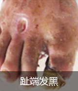 趾端發黑(hēi)
